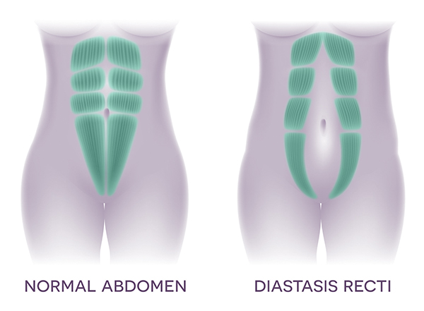 Diastasis Rectus Abdominis Dra Body In Balance